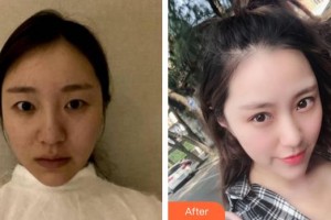 廈門(mén)張銘整醫(yī)療美容診所林平整形價(jià)格表附洛麗塔綜合美眼案例展示