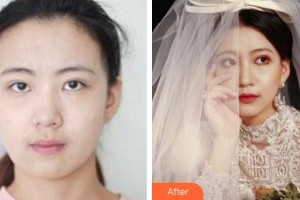 廈門(mén)海峽整形美容醫(yī)院賴(lài)炳招整形價(jià)格表附熱瑪吉案例展示