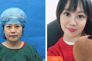 袁純新整形價(jià)格表附不開(kāi)刀祛眼袋+自體脂肪填充淚案例展示