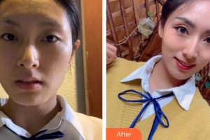 廈門(mén)莫琳娜醫(yī)療美容門(mén)診部張新合整形價(jià)格表附埋線提升案例展示