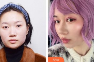 廈門(mén)修志夫整形美容醫(yī)院張寶譽(yù)整形價(jià)格表附埋線雙眼皮+去脂案例展示