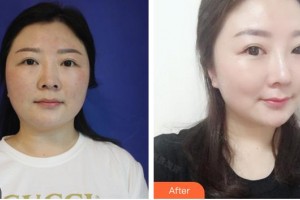 廈門(mén)莫琳娜醫(yī)療美容門(mén)診部邊大偉整形價(jià)格表附鼻修復(fù)改鼻案例展示