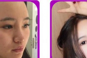 廈門(mén)市第一醫(yī)院思明分院整形外科徐洋整形價(jià)格表附鼻部整形案例展示