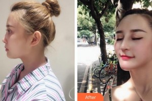 廈門(mén)海峽整形美容醫(yī)院童晉文整形價(jià)格表附肋軟骨隆鼻案例展示