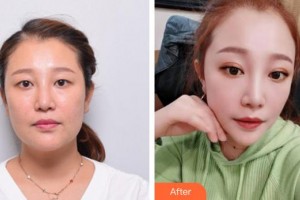 廈門(mén)大學(xué)附屬東南醫(yī)院燒傷整形科陳錦河整形價(jià)格表附埋線雙眼皮+去脂案例展示