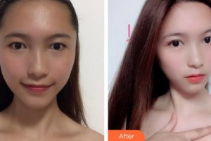 廈門(mén)海峽整形美容醫(yī)院張宏整形價(jià)格表附洛麗塔眼部手術(shù)案例展示