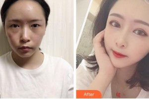 廈門(mén)莫琳娜醫(yī)療美容門(mén)診部陳石海整形價(jià)格表附新月桃花眼部手術(shù)案例展示