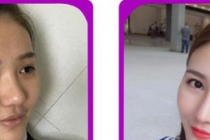 廈門(mén)華美名媛整形美容醫(yī)院賈虹整形價(jià)格表附鼻部手術(shù)案例展示