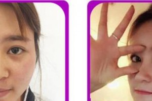 廈門(mén)張銘整醫(yī)療美容診所沈克琦整形價(jià)格表附牙齒矯正案例展示