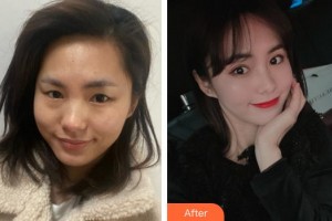 廈門(mén)張銘整醫(yī)療美容診所林潮整形價(jià)格表附眼部綜合案例展示