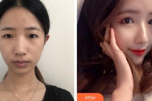 廈門(mén)張銘整醫(yī)療美容診所陳明整形價(jià)格表附眼部整形案例展示