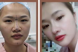 廈門莫琳娜醫(yī)療美容門診部張少軍整形價格表附隆鼻案例展示