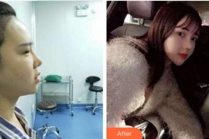 廈門黃巖整形美容醫(yī)院黃巖整形價格表附鼻部整形案例展示