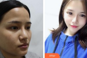 廈門市第一醫(yī)院思明分院整形外科張民福整形價格表附異體骨綜合隆鼻案例展示