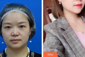 廈門海峽整形美容醫(yī)院尹衛(wèi)東整形價格表附鼻部整形案例展示