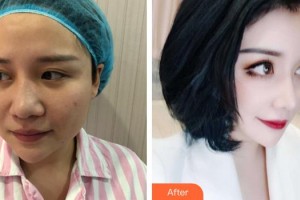 陳春水整形價格表附隆鼻修復(fù)+精微眼部手術(shù)案例展示