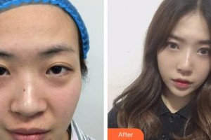 廈門莫琳娜醫(yī)療美容門診部陳麗萍整形價格表附硅膠隆鼻 全立體生態(tài)隆鼻案例展示