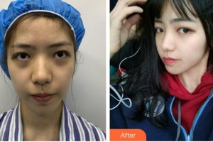 廈門莫琳娜醫(yī)療美容門診部阮南杰整形價格表附面部埋線提升案例展示