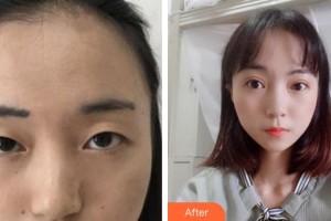 廈門莫琳娜醫(yī)療美容門診部游勝龍整形價格表附眼部綜合案例展示