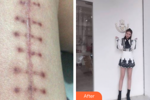 廣州尚美善造美容醫(yī)院邵方整形價格表附微創(chuàng)疤痕修復(fù)案例展示