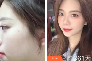 廣州醫(yī)學(xué)院口腔醫(yī)院張清彬整形價格表附骨性齙牙矯正案例展示