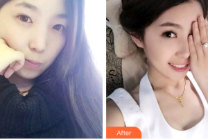 廣州醫(yī)學(xué)院口腔醫(yī)院李商輝整形價格表附牙齒隱形矯正案例展示