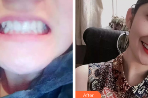 廣州醫(yī)學(xué)院口腔醫(yī)院張兆強住院醫(yī)師整形價格表附牙齒矯正案例展示