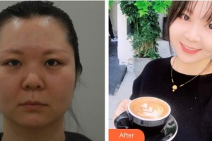 廈門銀河整形美容醫(yī)院崔英煥整形價格表附抗衰案例展示