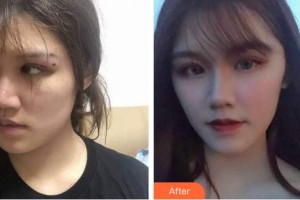 廈門銀河整形美容醫(yī)院孫玉香整形價格表附抗衰案例展示