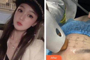 廈門新開元醫(yī)院整形美容中心郭友軍整形價格表附面部熱瑪吉案例展示