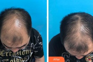 廈門銀河整形美容醫(yī)院呂巧云整形價格表附脫發(fā)調節(jié)重在堅持案例展示