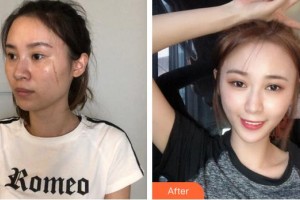 廈門新開元醫(yī)院整形美容中心姜善潤整形價格表附凹陷疤痕案例展示