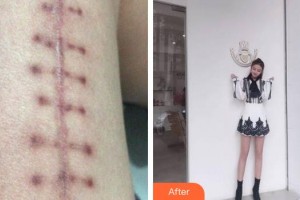 廈門新開元醫(yī)院整形美容中心簡銘成整形價格表附微創(chuàng)疤痕修復案例展示