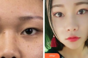 廈門海峽整形美容醫(yī)院劉歆整形價格表附眼部手術案例展示