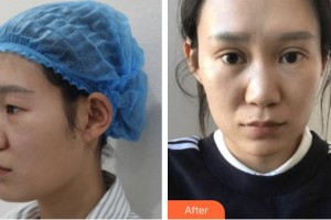 廈門大學附屬中山醫(yī)院整形美容科洪素莊整形價格表附雙眼皮案例展示