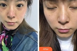 廈門福華醫(yī)療美容診所蔡怡庭整形價格表附超激光美膚祛斑案例展示