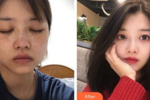 廈門張銘整醫(yī)療美容診所張小玲整形價格表附激光美膚案例展示