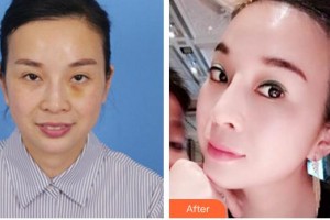 廈門華美名媛整形美容醫(yī)院陳運生整形價格表附埋線提升案例展示