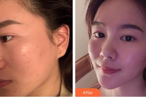 廈門華美名媛整形美容醫(yī)院翁秋霞整形價格表附激光美膚激光案例展示