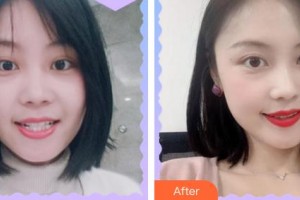 朱文碩整形價格表附牙齒隱形矯正案例展示