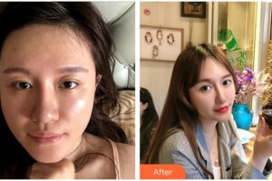 姚瑤整形價格表附“埋線提升”進口P丙二醇可吸案例展示