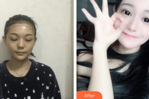 廈門華美名媛整形美容醫(yī)院陳燕喜整形價格表附種植發(fā)際線案例展示