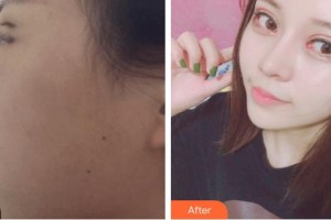 廈門薇格整形外科門診部俞翰秀整形價格表附雙眼皮案例展示