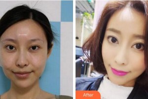 廈門薇格整形外科門診部尹惠蘭整形價格表附埋線提升案例展示