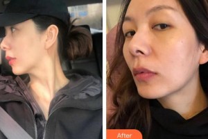 廈門安黛美整形外科門診部邱健欽整形價格表附熱瑪吉案例展示