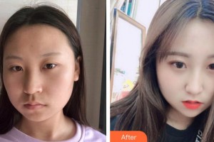 廈門海峽整形美容醫(yī)院何海霞整形價格表附埋線提升案例展示