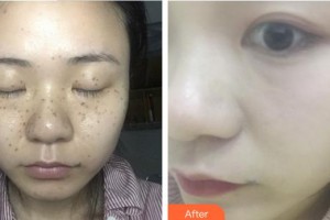 廈門華美名媛整形美容醫(yī)院張芳媛整形價格表附激光美膚激光案例展示