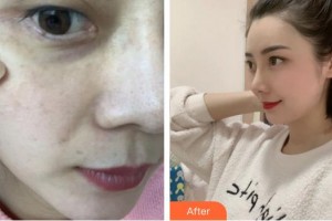 廈門福華醫(yī)療美容診所金貴香整形價格表附超激光美膚祛斑案例展示