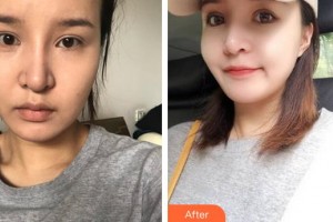 廈門華美名媛整形美容醫(yī)院張曉英整形價格表附埋線提升案例展示