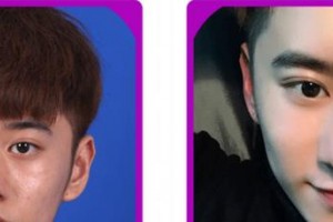 廈門修志夫整形美容醫(yī)院周璟整形價格表附隆鼻案例展示